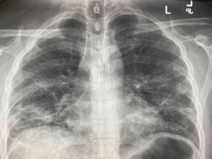 Chest X-Ray Findings in 636 Ambulatory Patients with COVID-19 Presenting to an Urgent Care ...