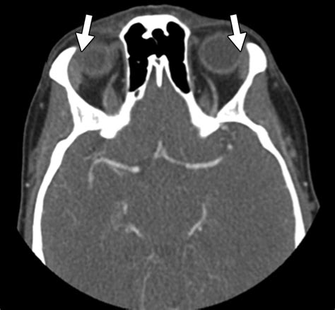 Lacrimal Gland Masses | AJR