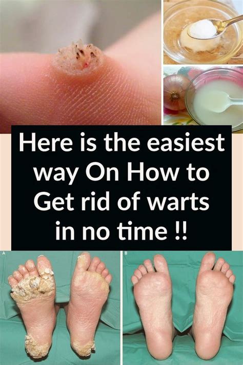 Here is the easiest way On How to Get rid of warts in no time !! - Tips ...