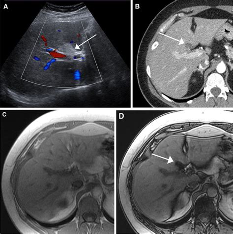 LI-RADS US-1: negative. Example of US-1 observation on screening exam... | Download Scientific ...