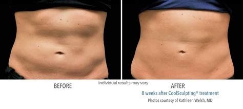 Cool Sculpting Hesperia | Cool Sculpting Redlands - Melt The Fat Away