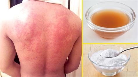 How to Get Rid of Hives at Home With Natural Home Remedies - YouTube