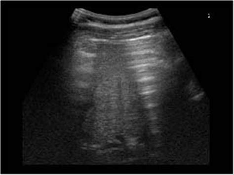 Abdomen and retroperitoneum | 1.6 Gastrointestinal tract : Case 1.6.5 Free intraperitoneal gas ...