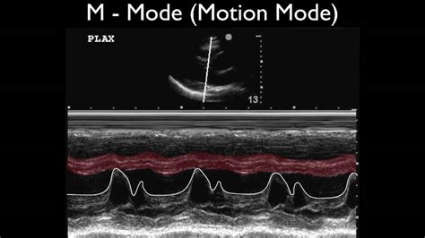 Ultrasound Physics Scanning Modes M Mode - YouTube