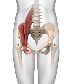 Iliopsoas Tendonitis Treatment Naples FL | Groin Pain Fort Myers, Bonita Springs Hip Trauma