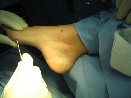 Pin en Hallux Valgus o Juanete