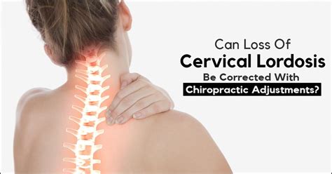 What Is Cervical Lordosis With Pictures