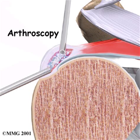 Shoulder Arthroscopy & Recovery