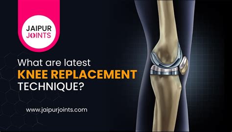 Latest Knee Replacement Technique in 2022 | TKR Surgeon in Jaipur