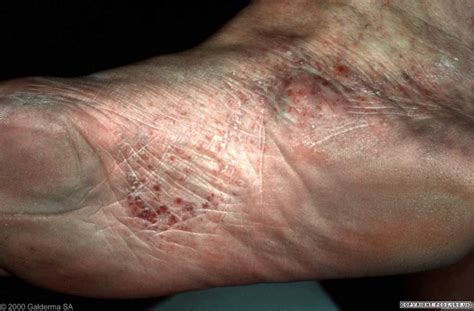 dyshidrotic eczema on feet - pictures, photos