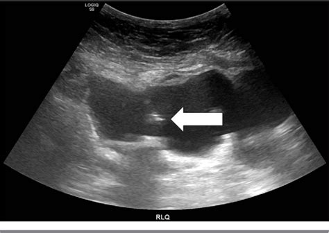 Figure 1 from Management of Indiana pouch stones through a percutaneous approach: A single ...