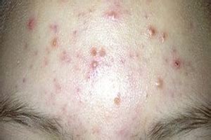 5 WORST ACNE MOST FEARED IN THE WORLD