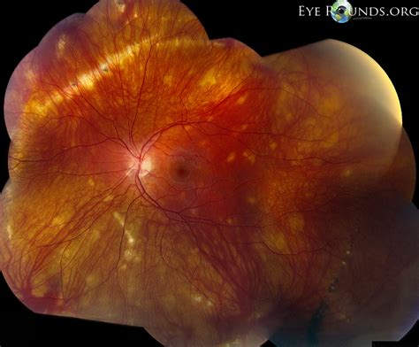 Atlas Entry - Multifocal choroiditis and panuveitis (MCP)