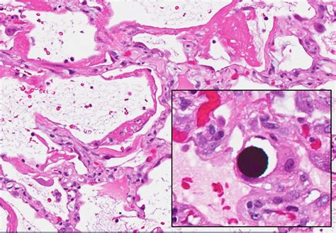 ALI w/ Hyaline Membranes — 6 Patterns of Pulmonary Pathology