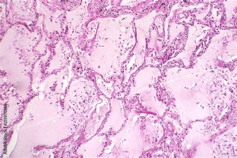 Histopathology of acute pulmonary edema, light micrograph showing accumulation of fluid inside ...