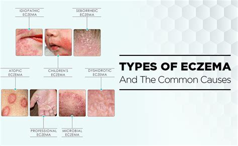 Different Types Of Eczema And It's Common Causes