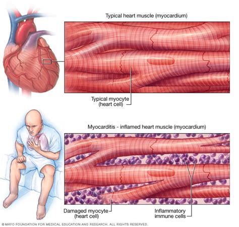 Myocarditis - Symptoms and causes - Mayo Clinic