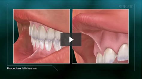 Labial Frenectomy - Cosmetic Dentistry