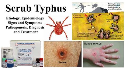 Scrub Typhus- Etiology, Epidemiology, Symptoms, Pathogenesis, Diagnosis and Treatment