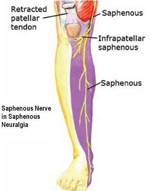 What Is and How to Use Saphenous Nerve Block | New Health Advisor