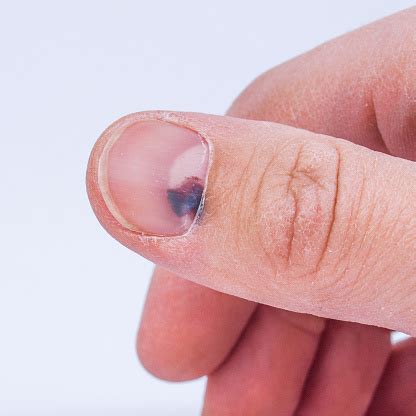 Subungual Hematoma Under Nail Stock Photo - Download Image Now - iStock