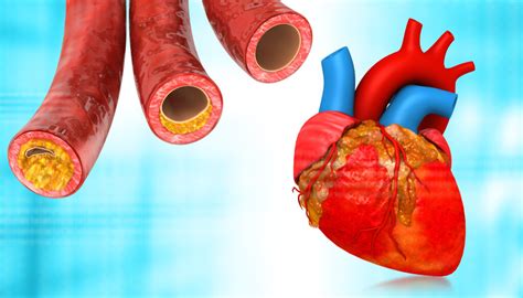 Why Excess Fat Around the Heart Is So Dangerous » Scary Symptoms