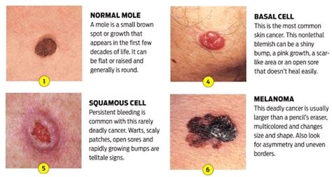 Warning Signs and Symptoms of Non-Melanoma Skin Cancer | Page 6 | Things Health