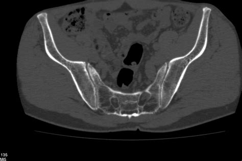 Sacroiliitis (CT) - radRounds Radiology Network