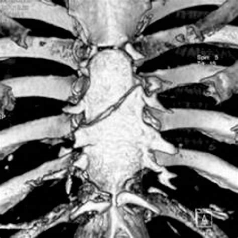 -Intraoperative finding of complete transverse sternal fracture. | Download Scientific Diagram