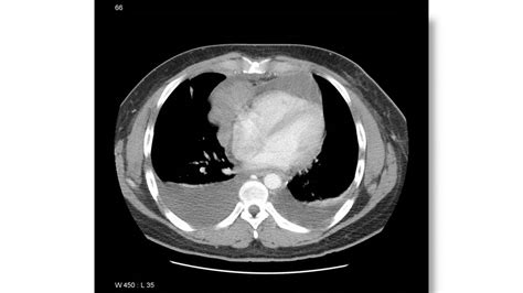 Primary mediastinal large B-cell lymphoma CT scan - wikidoc