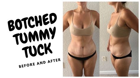 mini tummy tuck with muscle repair - laesserroegner-99