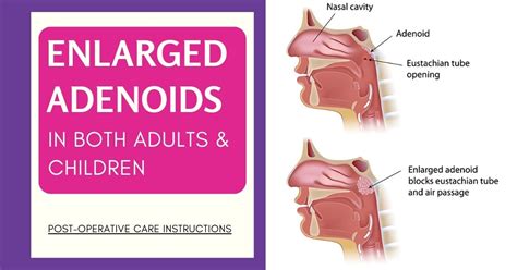 Adenoidectomy Before And After