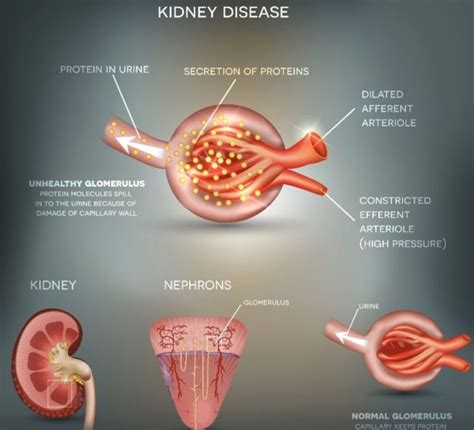 Diabetic Nephropathy | Dr.Ashwin Karuppan- Tambaram Medical Center