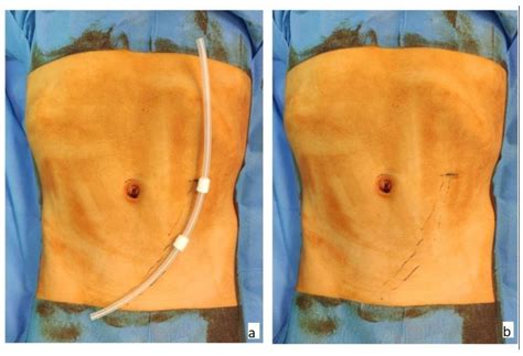 Medicina | Free Full-Text | Peritoneal Dialysis Catheter Placement in Children: Initial ...