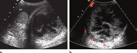 Intratesticular hematoma in a patient with continued scrotal swelling 1... | Download Scientific ...