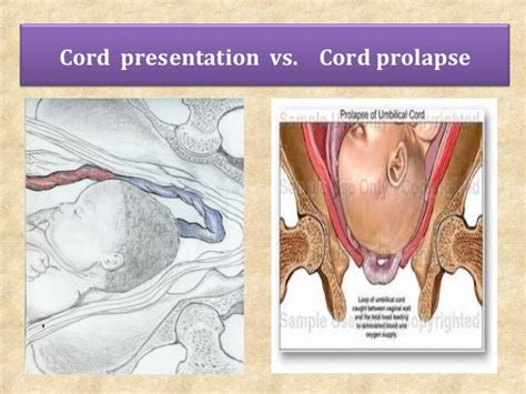 Cord prolpase for undergraduate