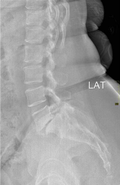 All About L5-S1 (Lumbosacral Joint) Spine-health, 40% OFF