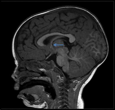 The foramen of Monro: a review of its anatomy, history, pathology, and ...