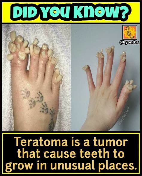 DID You Know? Teratoma is a tumor that cause teeth to grow in unusual places. - )