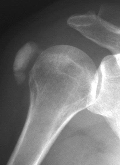 Calcific bursitis | Radiology | Radiology, Teaching materials