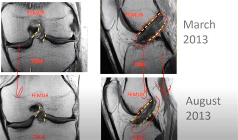 ACL MRI Evidence for the Perc-ACLR | Centeno-Schultz Clinic