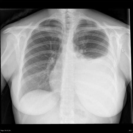 Loculated Pleural Effusion - Pleural Effusion Im Reference / Loculated ...