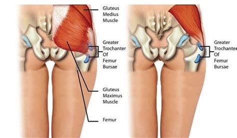 Lateral Hip Pain | Results Physiotherapy Chandler