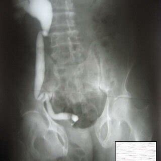 (PDF) Late Presentation of Ectopia Vesica with Malignant Transformation