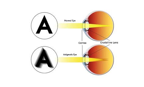 Astigmatism | Look & See Eyecare