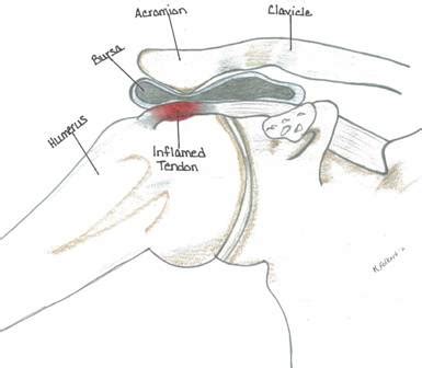 Treatment for Impingement Syndrome in Nebraska