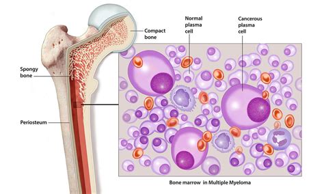 Multiple Myeloma | Zantac Lawsuit