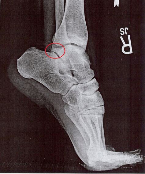 Insertional Achilles Tendinopathy - differential diagnosis and ...