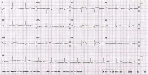 Nondominant Right Coronary Artery Occlusion: Small Vessel, Dramatic ...