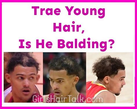 Trae Young Hair, Is He Balding?